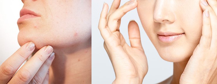 Skin health transformation showing improved complexion from probiotic supplements usage
